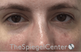 Tear Trough / Under Eye Fillers Before & After Gallery - Patient 185860881 - Image 2