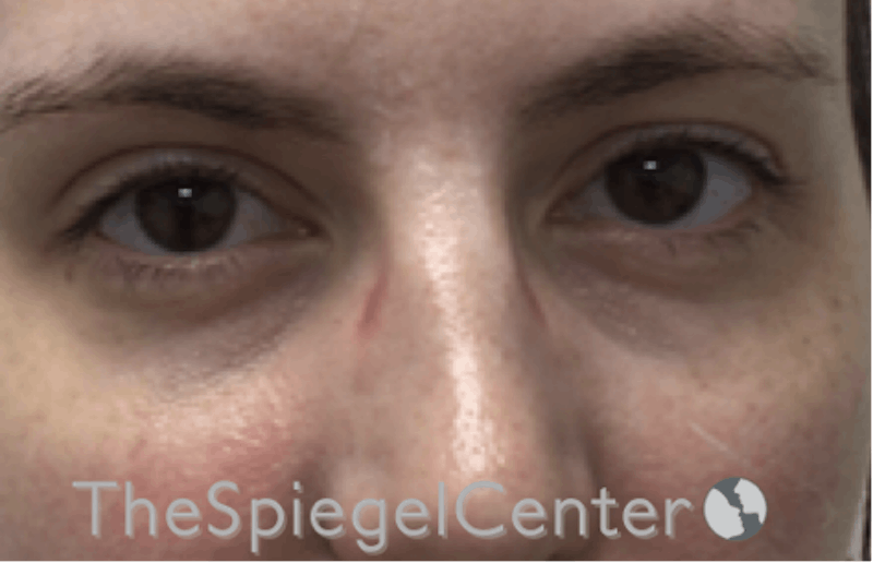 Tear Trough / Under Eye Fillers Before & After Gallery - Patient 185860881 - Image 1