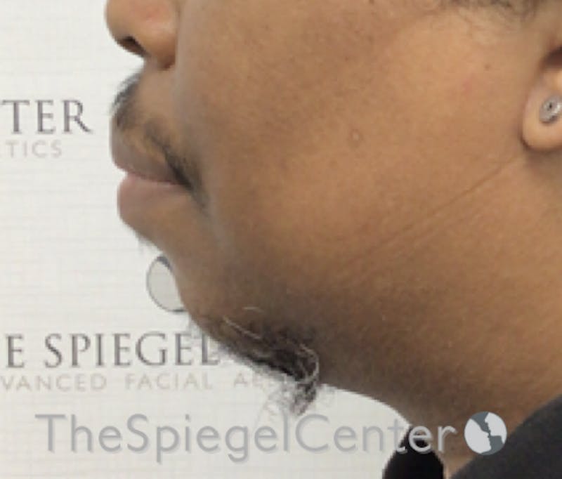 Chin Augmentation Before & After Gallery - Patient 188332322 - Image 3