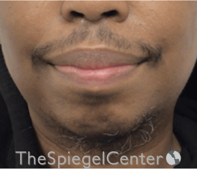 Chin Augmentation Before & After Gallery - Patient 188332322 - Image 1
