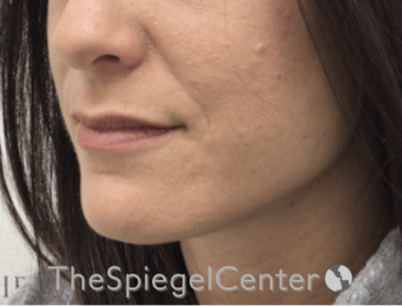 Nasolabial Fold Filler Before & After Gallery - Patient 189141777 - Image 2