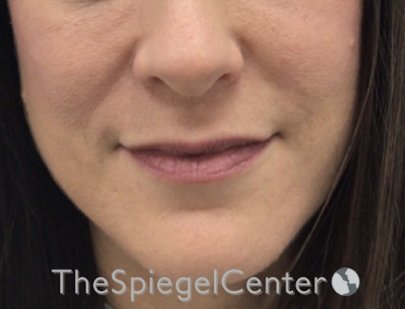 Nasolabial Fold Filler Before & After Gallery - Patient 189141777 - Image 3