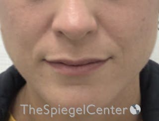 Nasolabial Fold Filler Before & After Gallery - Patient 189141777 - Image 4