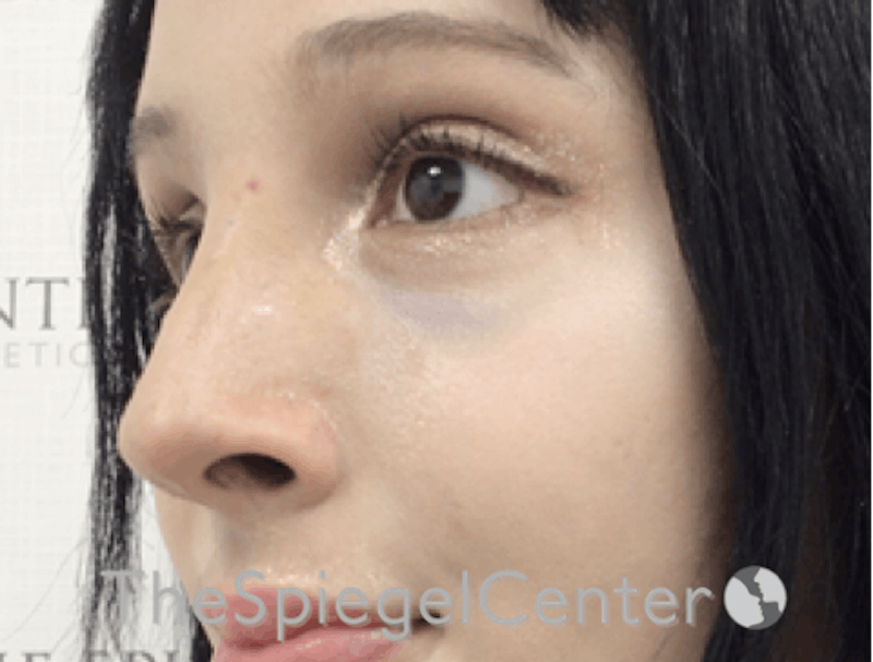 Revision Rhinoplasty Before & After Gallery - Patient 189141780 - Image 2
