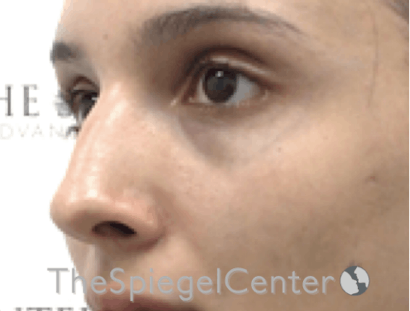 Revision Rhinoplasty Before & After Gallery - Patient 189141780 - Image 1