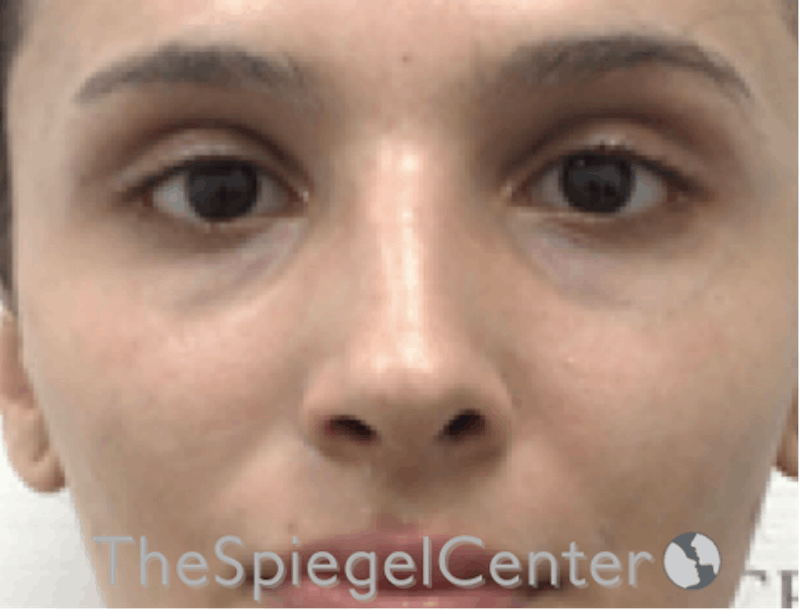 Revision Rhinoplasty Before & After Gallery - Patient 189141780 - Image 3