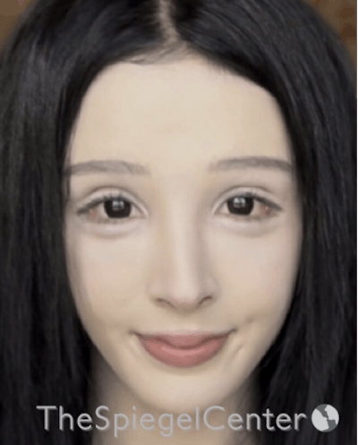 FFS Before & After Gallery - Patient 189141804 - Image 4