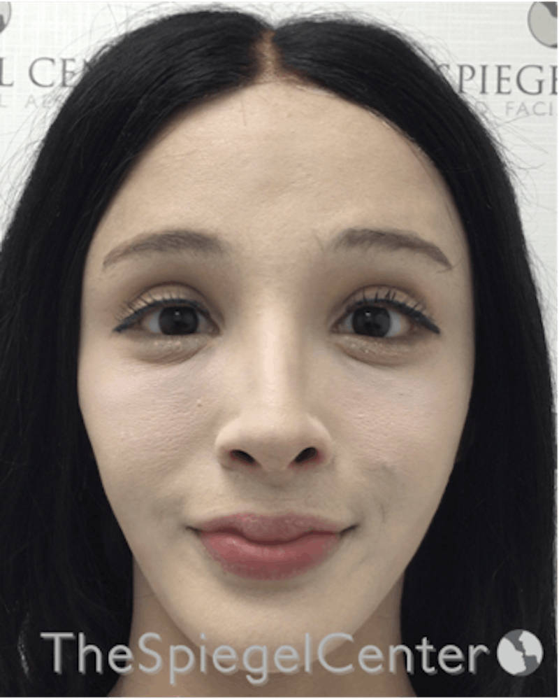FFS Before & After Gallery - Patient 189141804 - Image 2