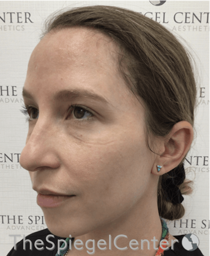 Morpheus8 Before & After Gallery - Patient 189142413 - Image 1