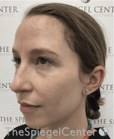 Morpheus8 Before & After Gallery - Patient 189142413 - Image 1