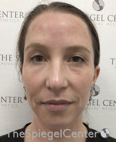 Morpheus8 Before & After Gallery - Patient 189142413 - Image 3
