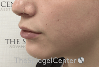 Lip Filler Before & After Gallery - Patient 192316769 - Image 6