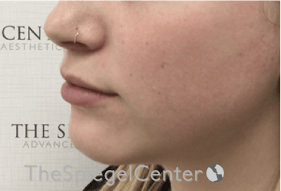 Lip Filler Before & After Gallery - Patient 192316769 - Image 5