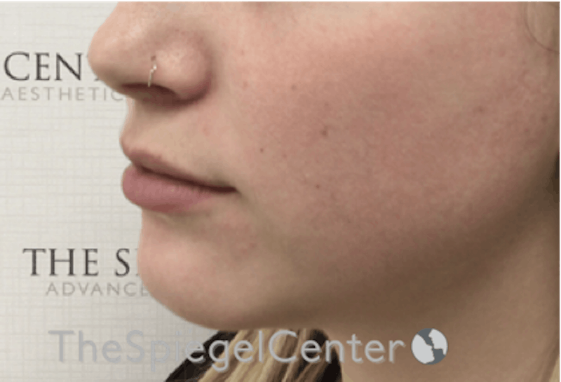 Lip Filler Before & After Gallery - Patient 192316769 - Image 5