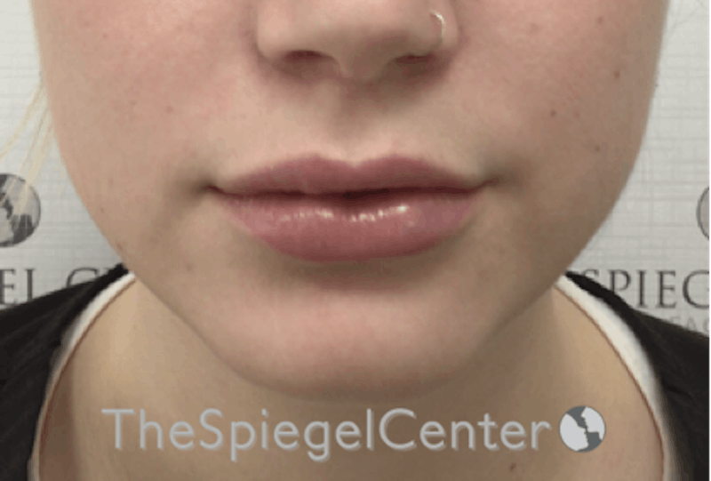 Lip Filler Before & After Gallery - Patient 192316769 - Image 4