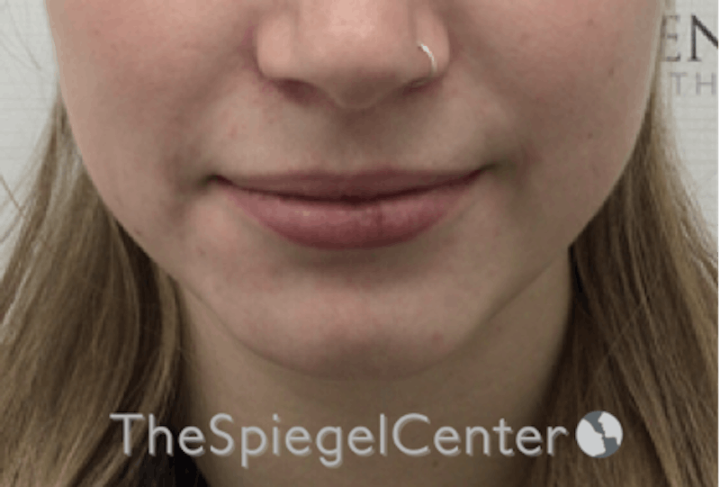 Lip Filler Before & After Gallery - Patient 192316769 - Image 3