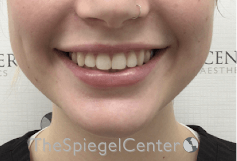 Lip Filler Before & After Gallery - Patient 192316769 - Image 2