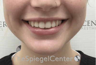 Lip Filler Before & After Gallery - Patient 192316769 - Image 2