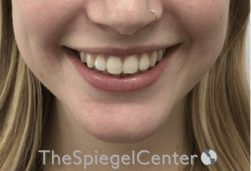 Lip Filler Before & After Gallery - Patient 192316769 - Image 1