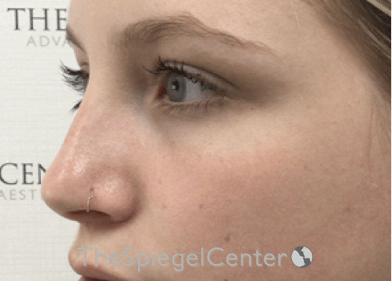Non-Surgical Rhinoplasty / Nose Filler Before & After Gallery - Patient 192316767 - Image 4