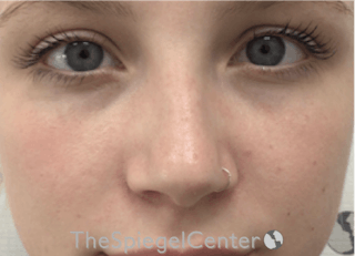 Non-Surgical Rhinoplasty / Nose Filler Before & After Gallery - Patient 192316767 - Image 2