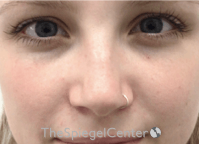 Non-Surgical Rhinoplasty / Nose Filler Before & After Gallery - Patient 192316767 - Image 1