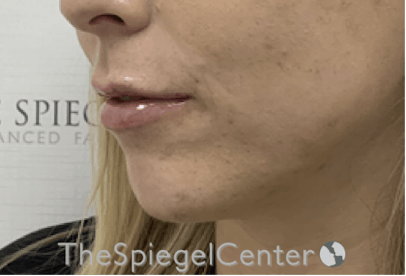 Lip Filler Before & After Gallery - Patient 192316761 - Image 6