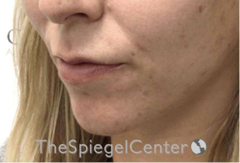 Lip Filler Before & After Gallery - Patient 192316761 - Image 5