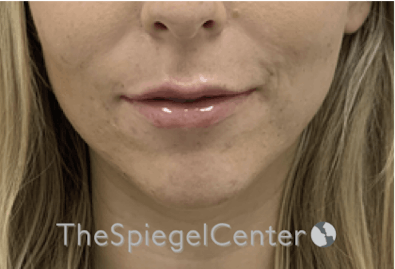 Lip Filler Before & After Gallery - Patient 192316761 - Image 4