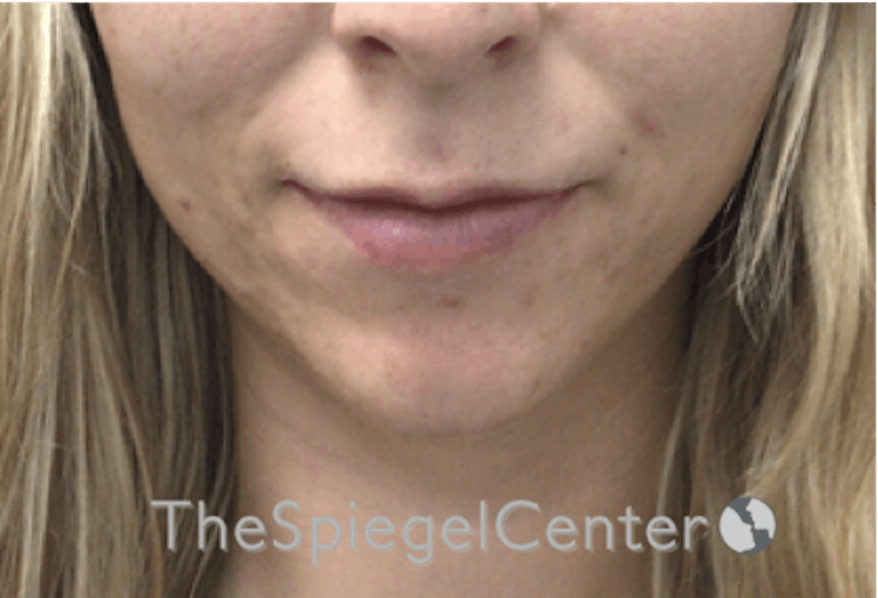 Lip Filler Before & After Gallery - Patient 192316761 - Image 3