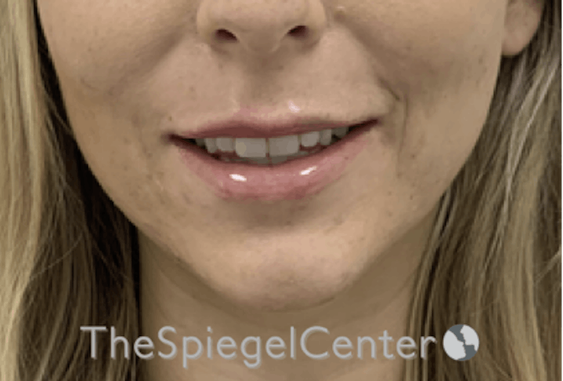 Lip Filler Before & After Gallery - Patient 192316761 - Image 2