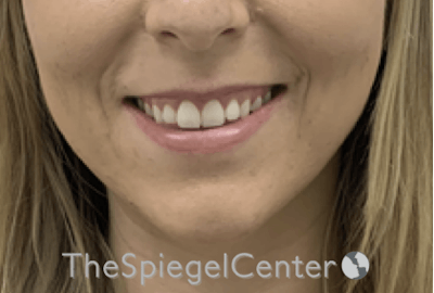 Lip Filler Before & After Gallery - Patient 192316761 - Image 1