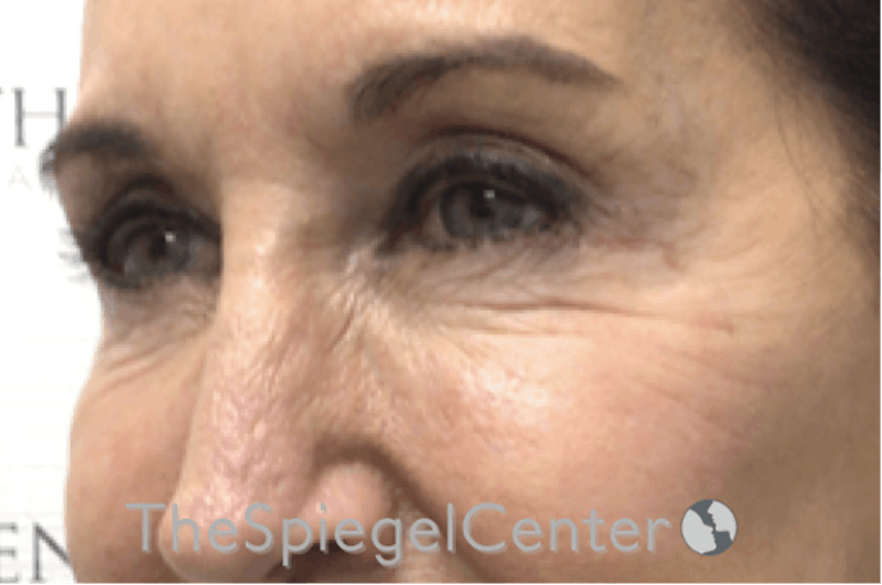 Blepharoplasty Before & After Gallery - Patient 192316770 - Image 3