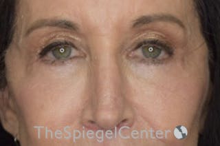 Blepharoplasty Before & After Gallery - Patient 192316770 - Image 2