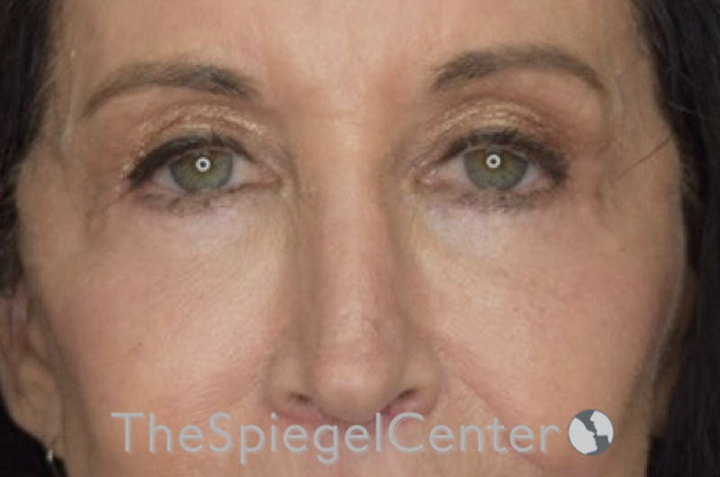 Blepharoplasty Before & After Gallery - Patient 192316770 - Image 2