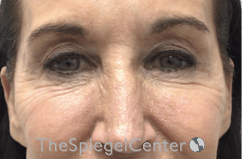 Blepharoplasty Before & After Gallery - Patient 192316770 - Image 1
