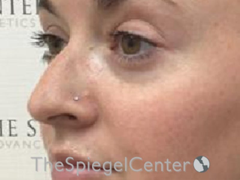 Non-Surgical Rhinoplasty / Nose Filler Before & After Gallery - Patient 192560571 - Image 3