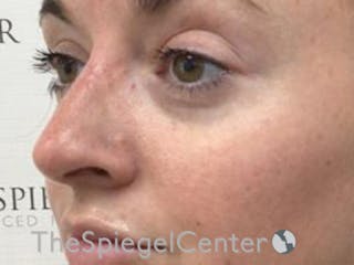 Non-Surgical Rhinoplasty / Nose Filler Before & After Gallery - Patient 192560571 - Image 4