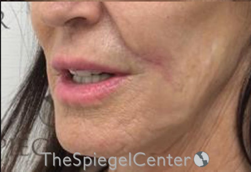 Lip Augmentation / Lip Implant / Lip Lift Before & After Gallery - Patient 192560610 - Image 3