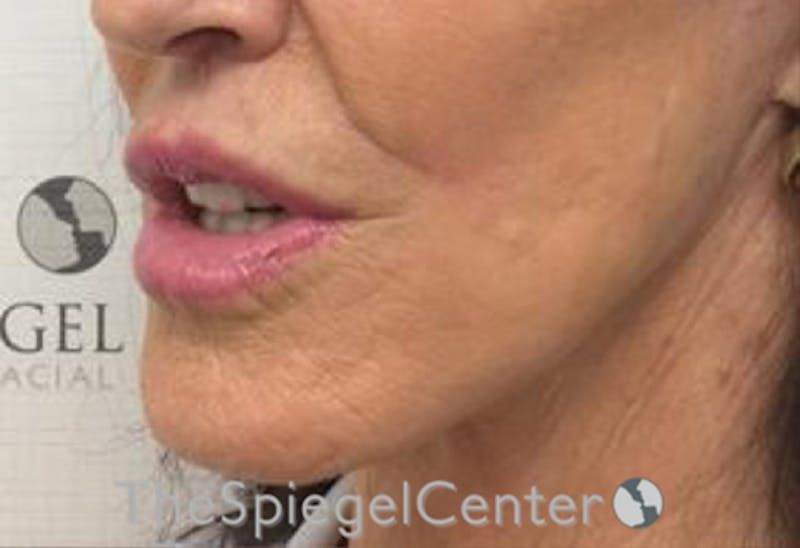 Lip Augmentation / Lip Implant / Lip Lift Before & After Gallery - Patient 192560610 - Image 4