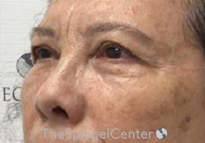 Blepharoplasty Before & After Gallery - Patient 192560612 - Image 3