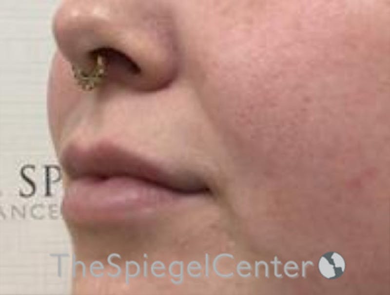 Lip Filler Before & After Gallery - Patient 192560617 - Image 6
