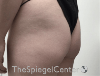 Liquid Butt Lift Before & After Gallery - Patient 195959265 - Image 4