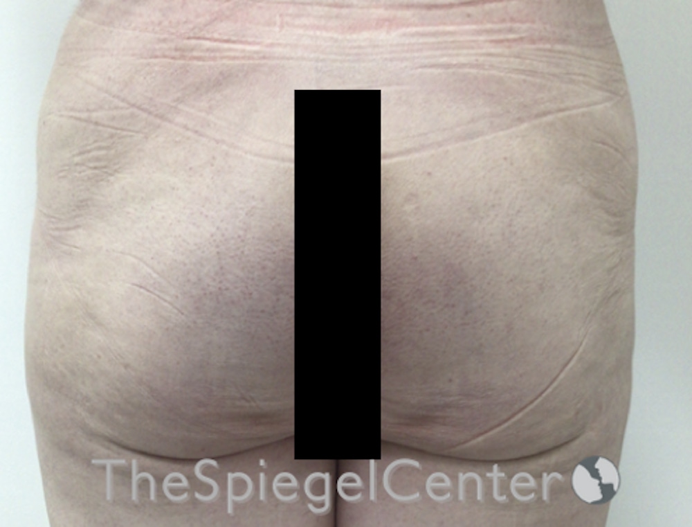 Non-Surgical Butt Lift