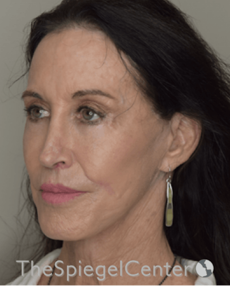 Facelift Before & After Gallery - Patient 193913022 - Image 4