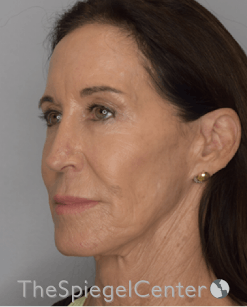 Facelift Before & After Gallery - Patient 193913022 - Image 3