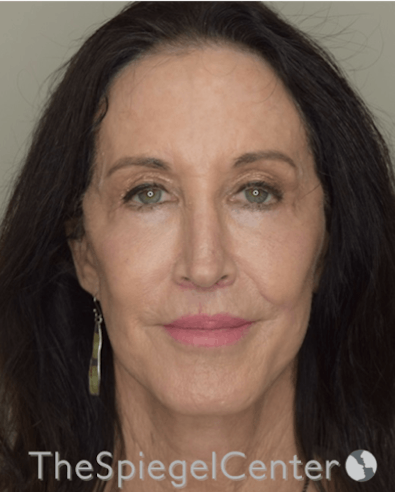 Facelift Before & After Gallery - Patient 193913022 - Image 2