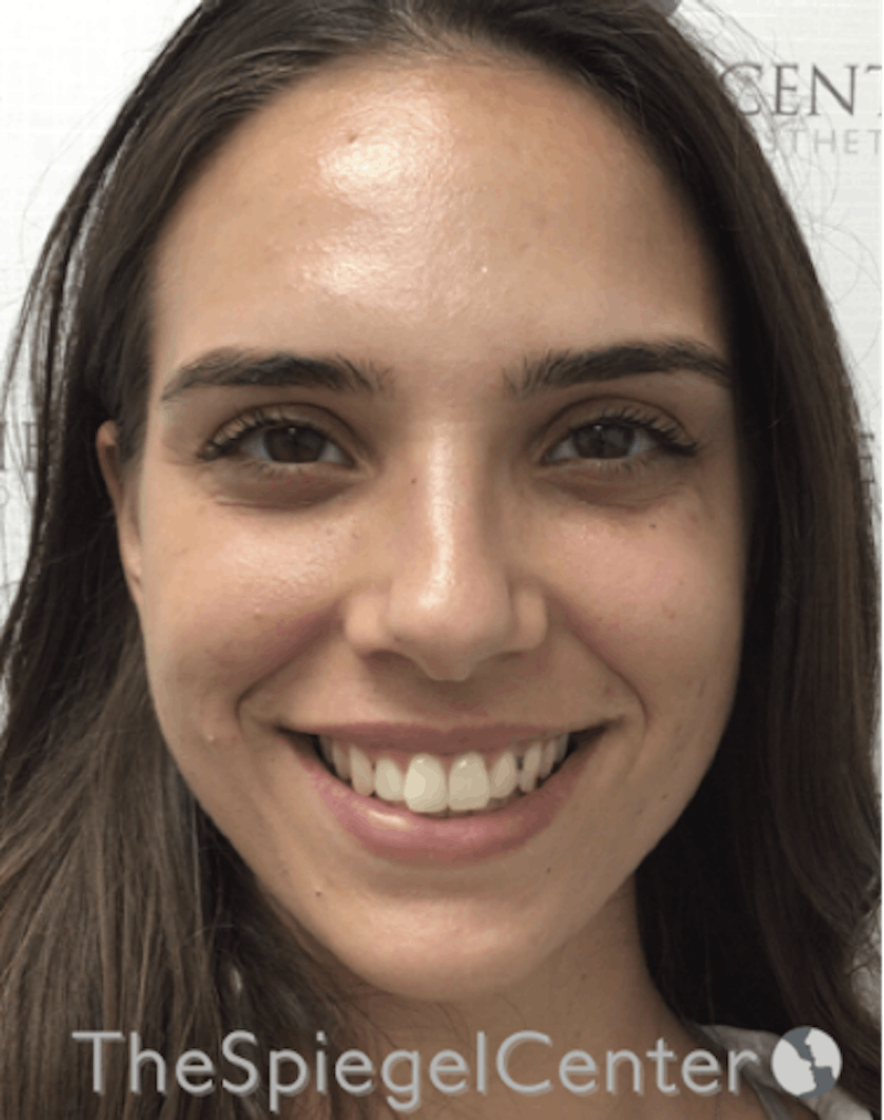Botox / Dysport / Jeuveau / Xeomin Before & After Gallery - Patient 193912871 - Image 4