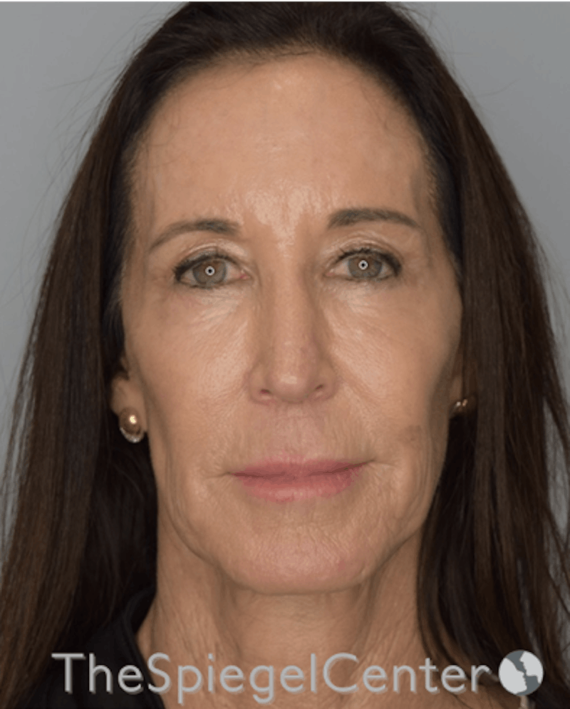 Facelift Before & After Gallery - Patient 193913022 - Image 1