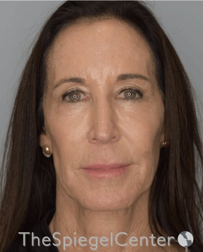 Facelift Before & After Gallery - Patient 193913022 - Image 1